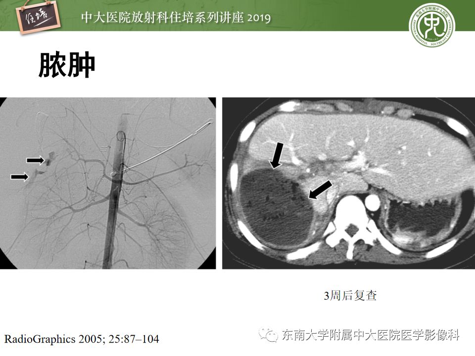 【PPT】腹腔实性脏器钝性外伤影像诊断