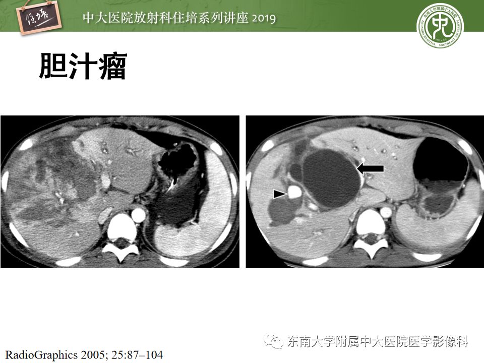 【PPT】腹腔实性脏器钝性外伤影像诊断