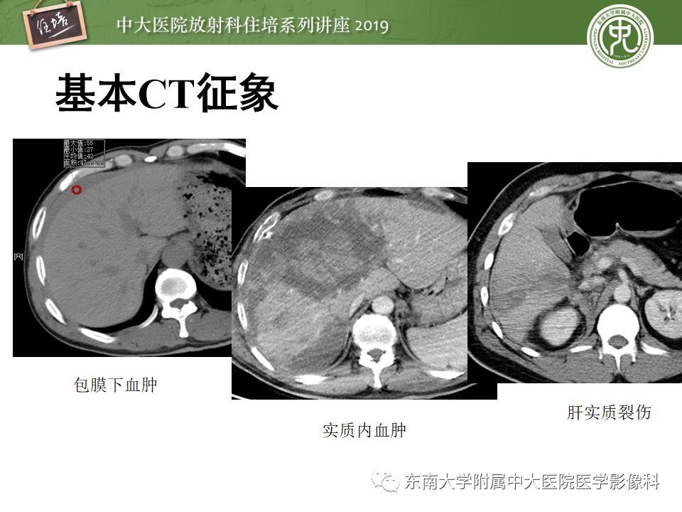 【PPT】腹腔实性脏器钝性外伤影像诊断