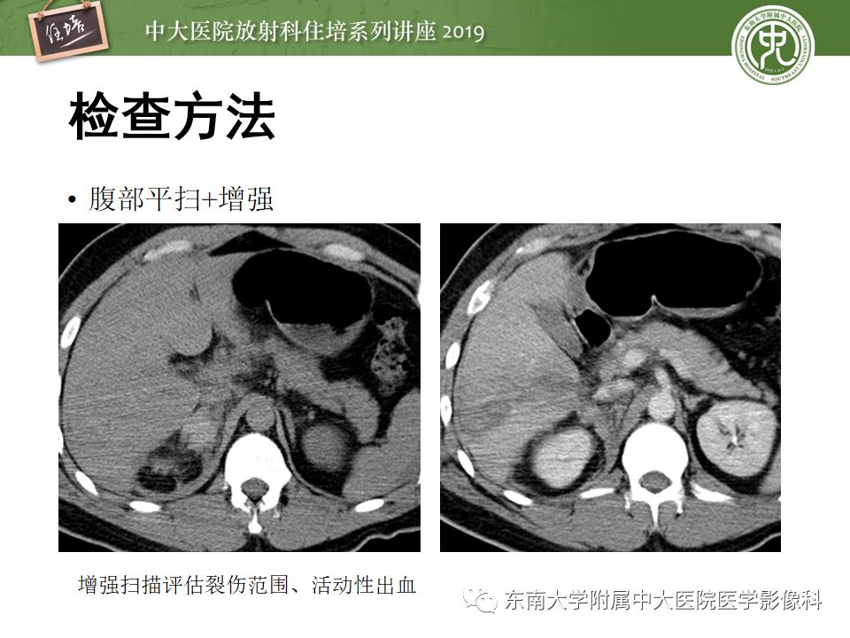 【PPT】腹腔实性脏器钝性外伤影像诊断