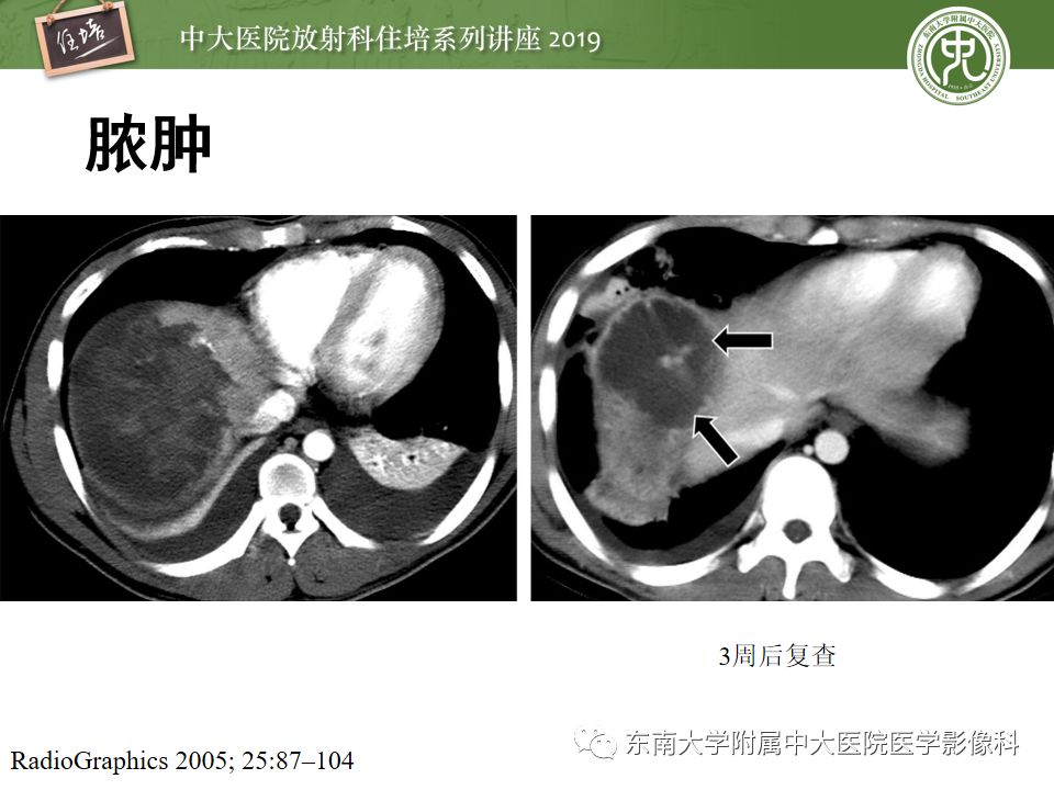 【PPT】腹腔实性脏器钝性外伤影像诊断