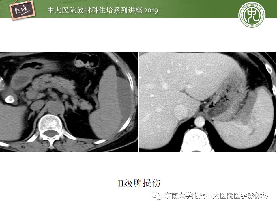 【PPT】腹腔实性脏器钝性外伤影像诊断