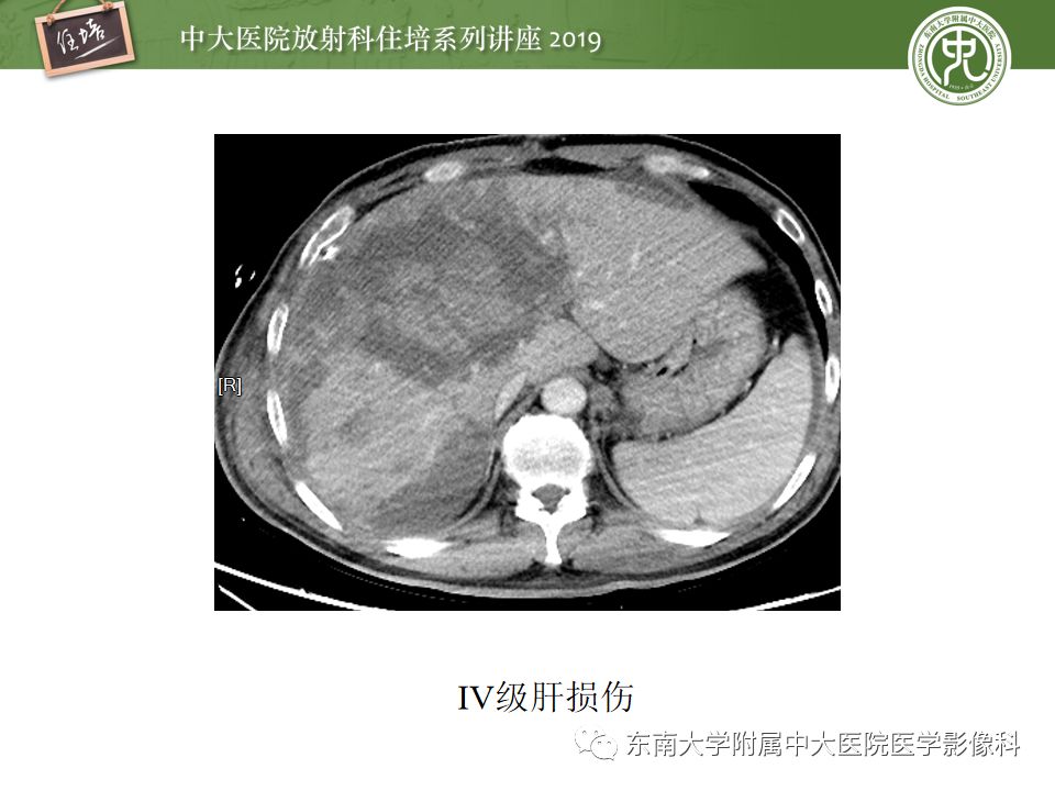 【PPT】腹腔实性脏器钝性外伤影像诊断
