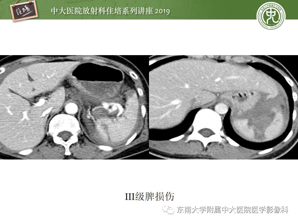 【PPT】腹腔实性脏器钝性外伤影像诊断
