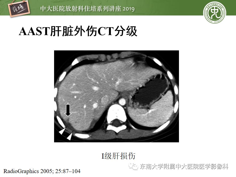 【PPT】腹腔实性脏器钝性外伤影像诊断