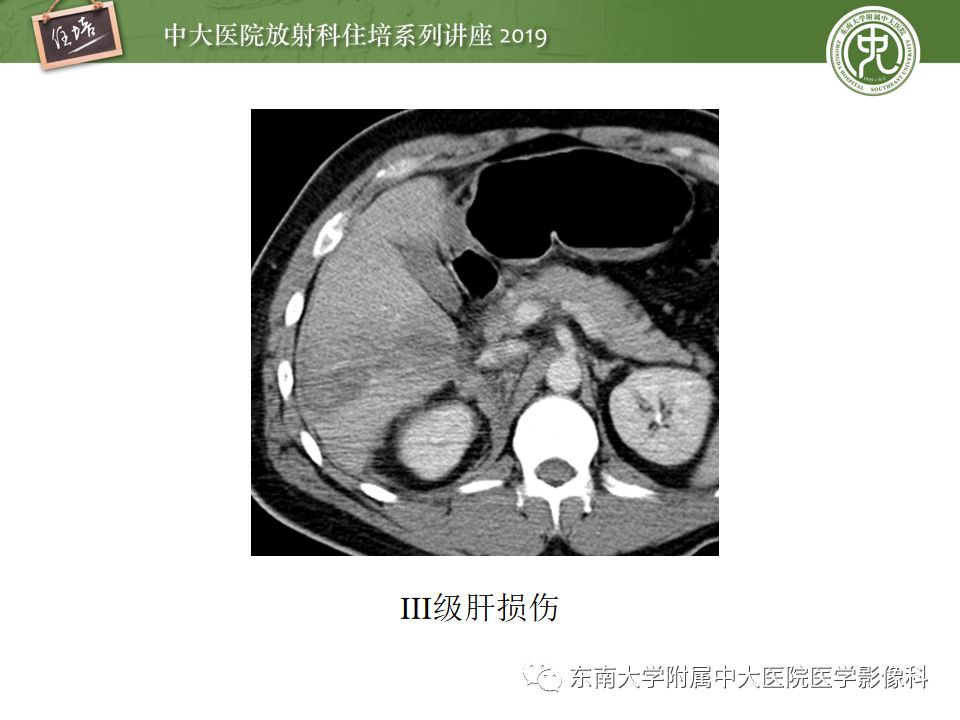 【PPT】腹腔实性脏器钝性外伤影像诊断