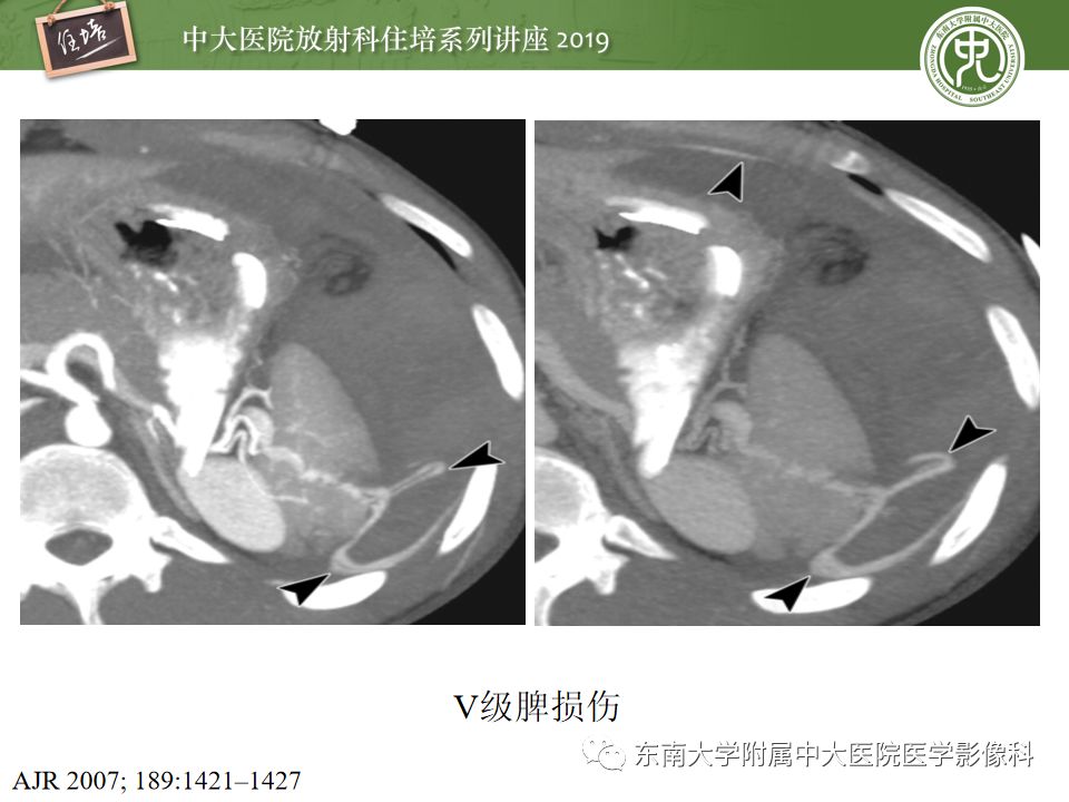 【PPT】腹腔实性脏器钝性外伤影像诊断