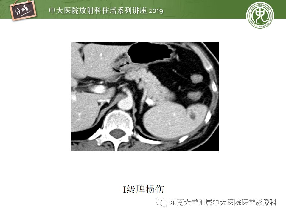 【PPT】腹腔实性脏器钝性外伤影像诊断