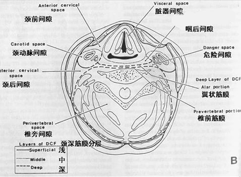 颈部解剖与常见疾病的影像特点