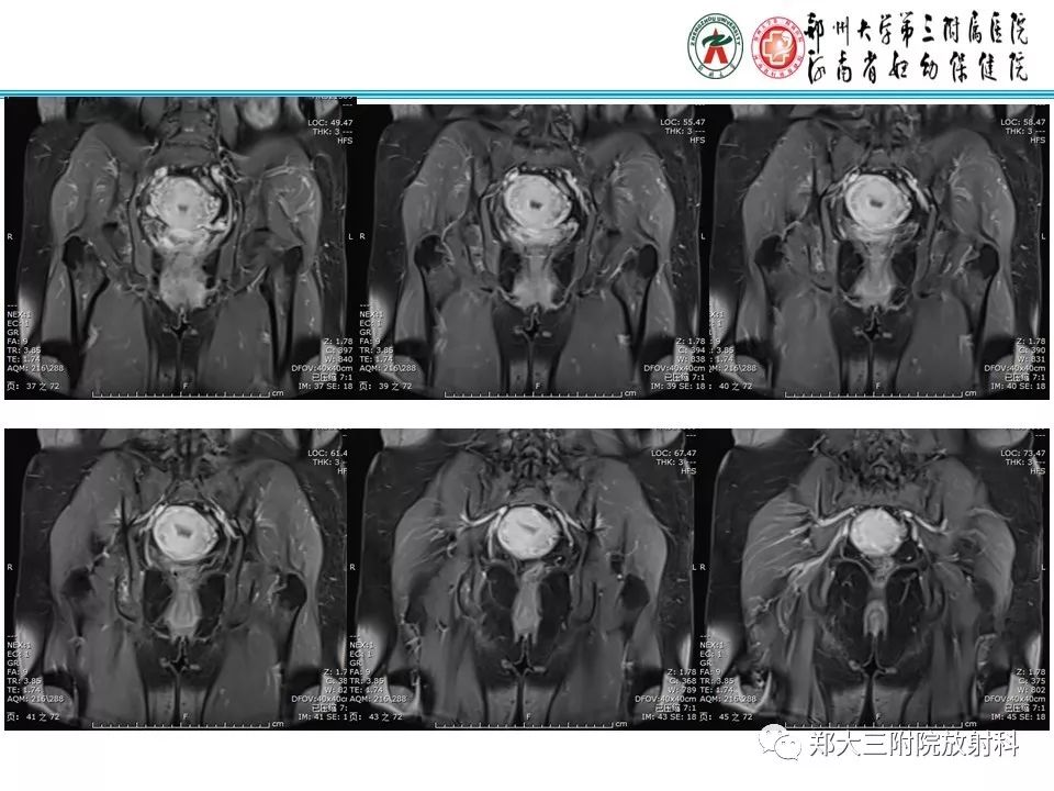 【病例】子宫静脉内平滑肌瘤病1例MR影像 【病例】子宫静脉内平滑肌瘤病1例MR影像