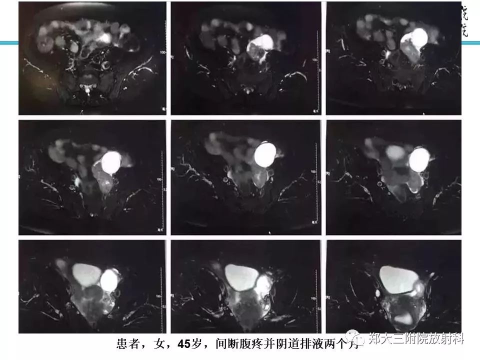 【病例】子宫静脉内平滑肌瘤病1例MR影像 【病例】子宫静脉内平滑肌瘤病1例MR影像