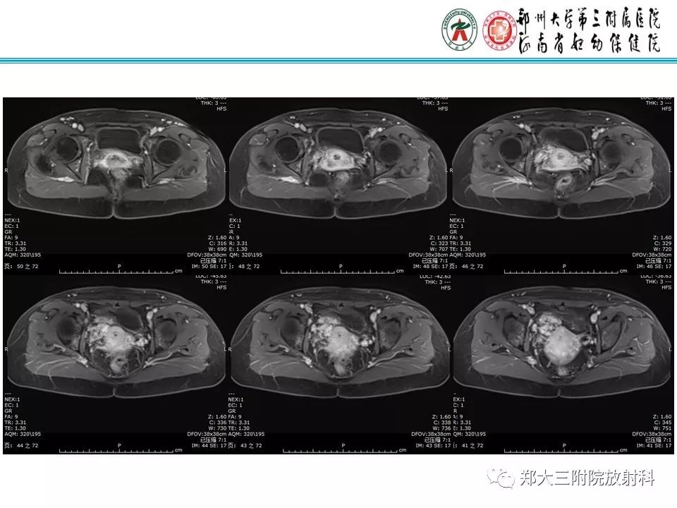 【病例】子宫静脉内平滑肌瘤病1例MR影像 【病例】子宫静脉内平滑肌瘤病1例MR影像