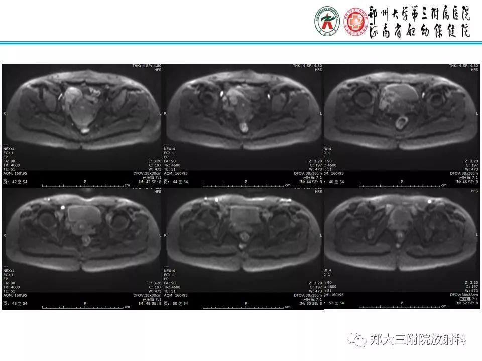【病例】子宫静脉内平滑肌瘤病1例MR影像 【病例】子宫静脉内平滑肌瘤病1例MR影像