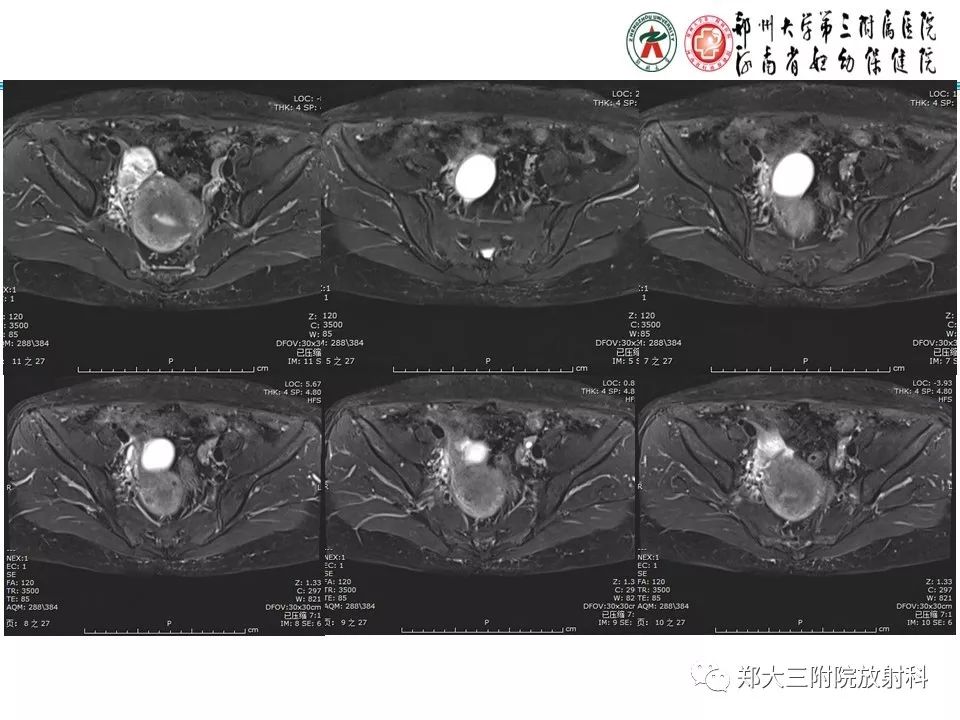 【病例】子宫静脉内平滑肌瘤病1例MR影像 【病例】子宫静脉内平滑肌瘤病1例MR影像