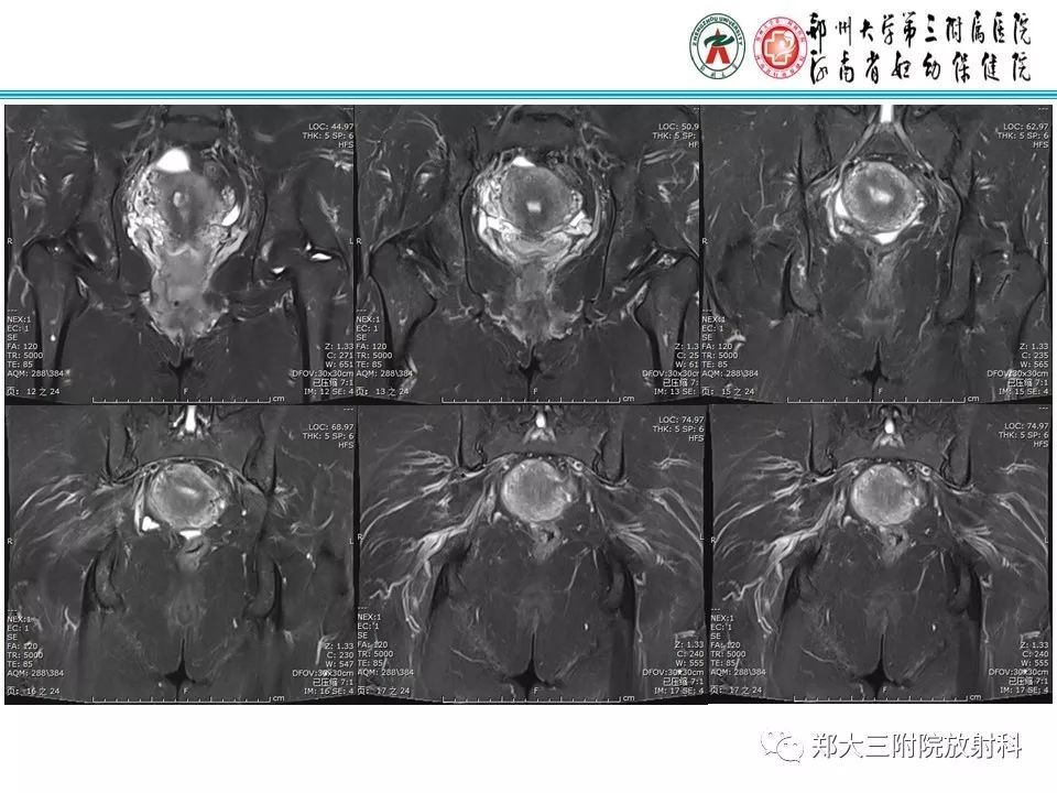 【病例】子宫静脉内平滑肌瘤病1例MR影像 【病例】子宫静脉内平滑肌瘤病1例MR影像
