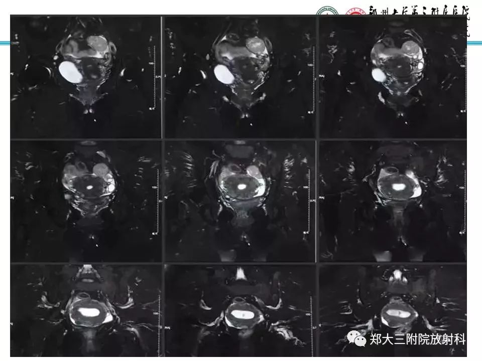 【病例】子宫静脉内平滑肌瘤病1例MR影像 【病例】子宫静脉内平滑肌瘤病1例MR影像