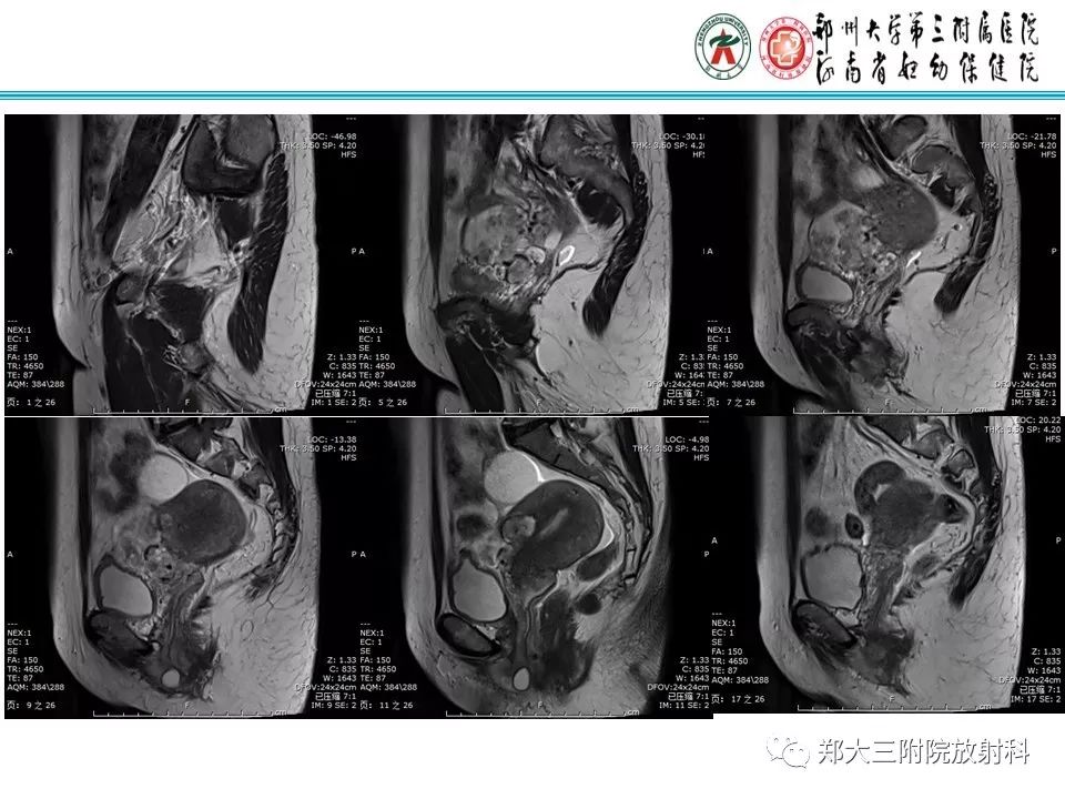 【病例】子宫静脉内平滑肌瘤病1例MR影像 【病例】子宫静脉内平滑肌瘤病1例MR影像