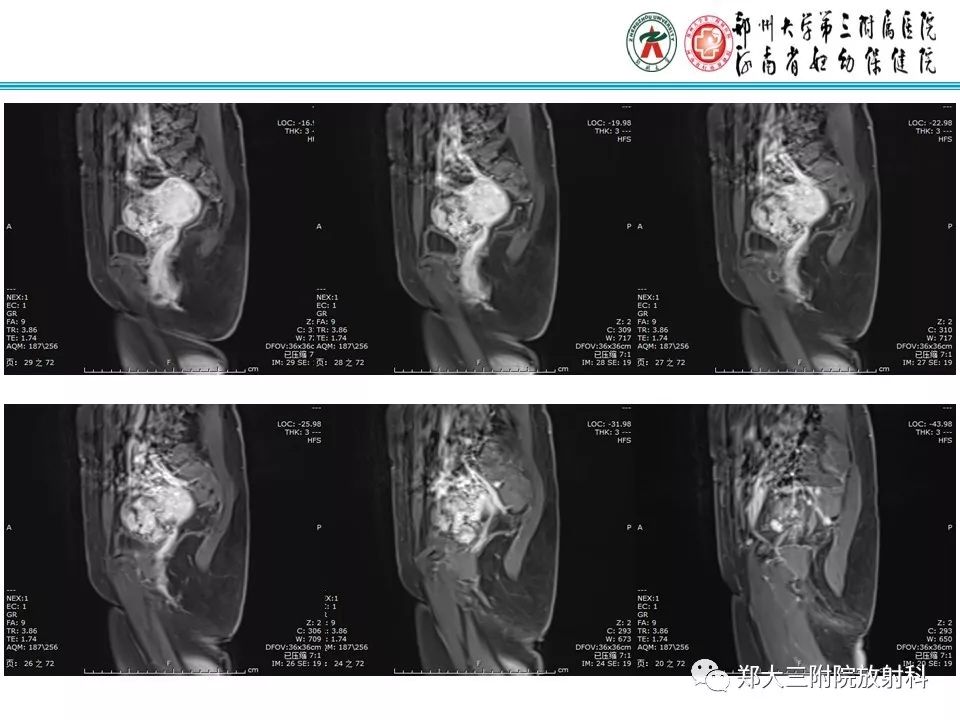 【病例】子宫静脉内平滑肌瘤病1例MR影像 【病例】子宫静脉内平滑肌瘤病1例MR影像