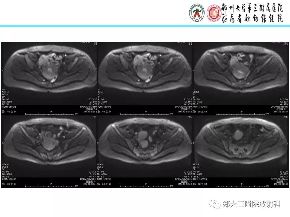 【病例】子宫静脉内平滑肌瘤病1例MR影像 【病例】子宫静脉内平滑肌瘤病1例MR影像