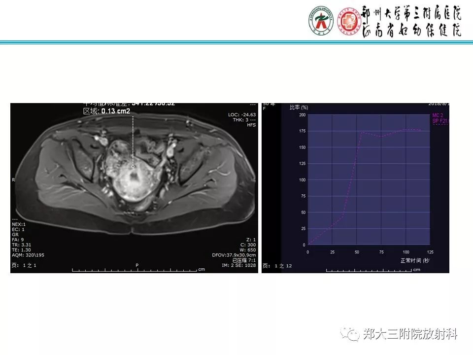 【病例】子宫静脉内平滑肌瘤病1例MR影像 【病例】子宫静脉内平滑肌瘤病1例MR影像