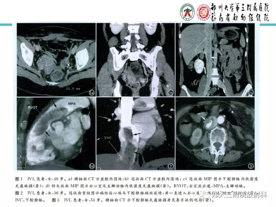 【病例】子宫静脉内平滑肌瘤病1例MR影像 【病例】子宫静脉内平滑肌瘤病1例MR影像