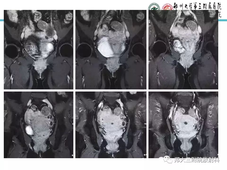 【病例】子宫静脉内平滑肌瘤病1例MR影像 【病例】子宫静脉内平滑肌瘤病1例MR影像