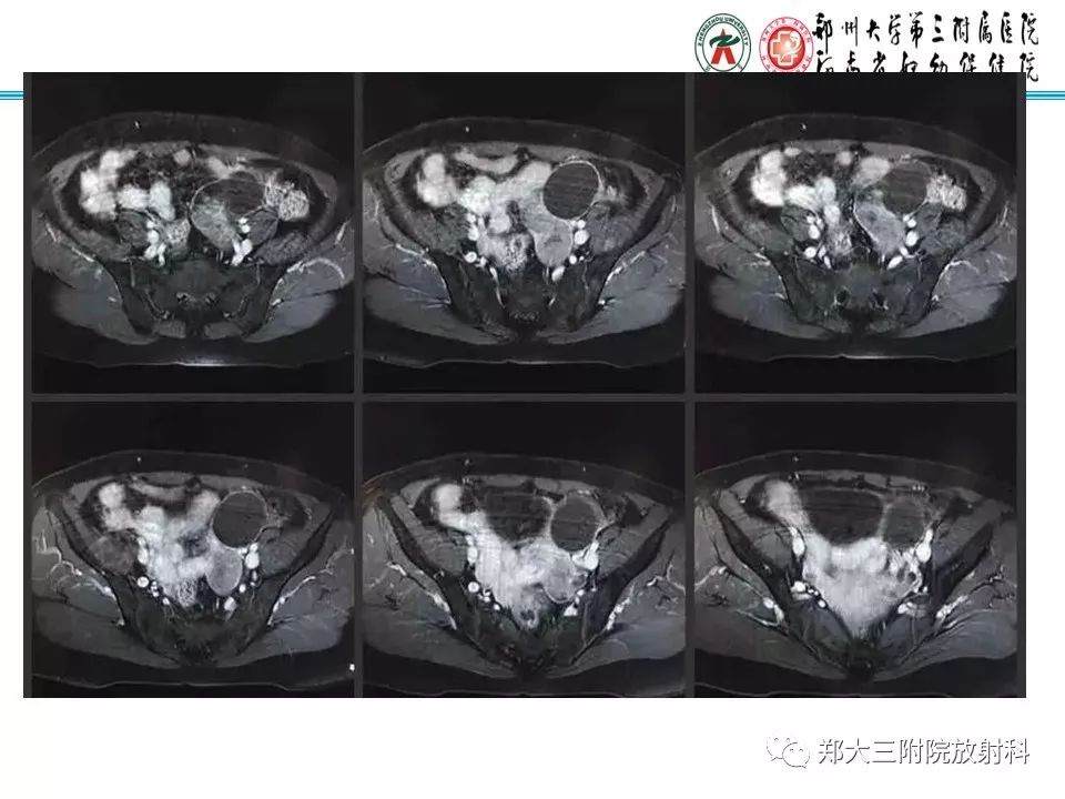 【病例】子宫静脉内平滑肌瘤病1例MR影像 【病例】子宫静脉内平滑肌瘤病1例MR影像
