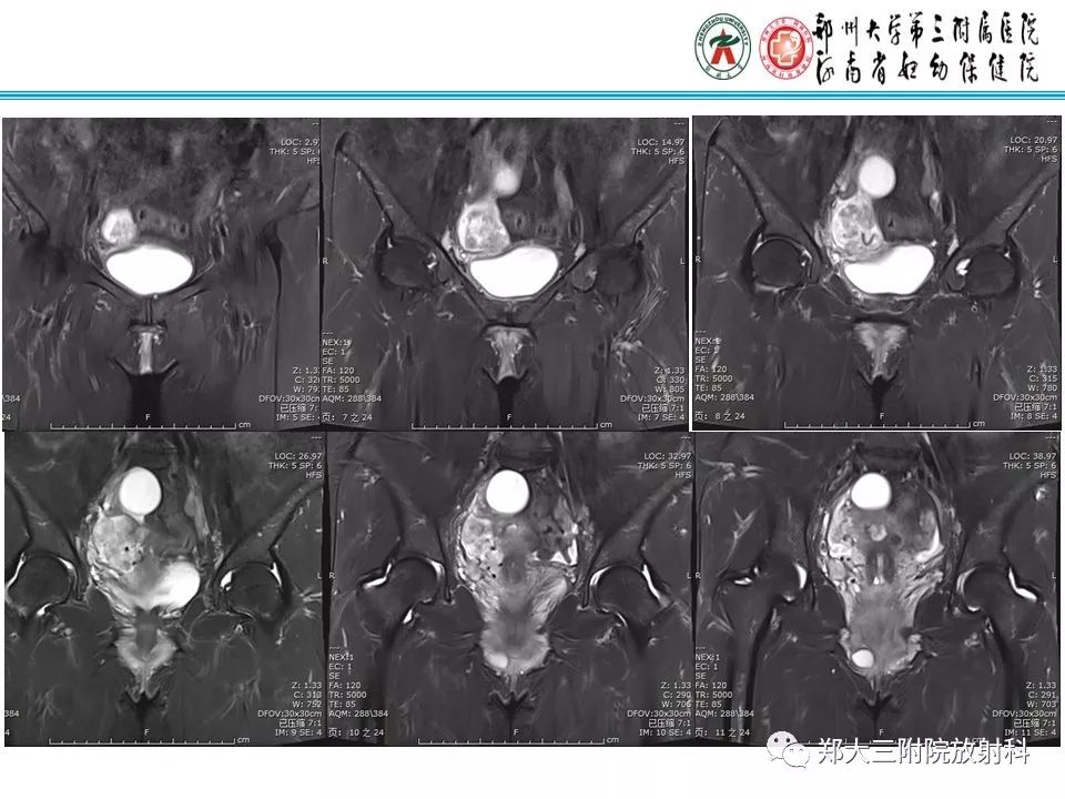 【病例】子宫静脉内平滑肌瘤病1例MR影像 【病例】子宫静脉内平滑肌瘤病1例MR影像