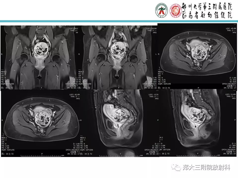 【病例】子宫静脉内平滑肌瘤病1例MR影像 【病例】子宫静脉内平滑肌瘤病1例MR影像