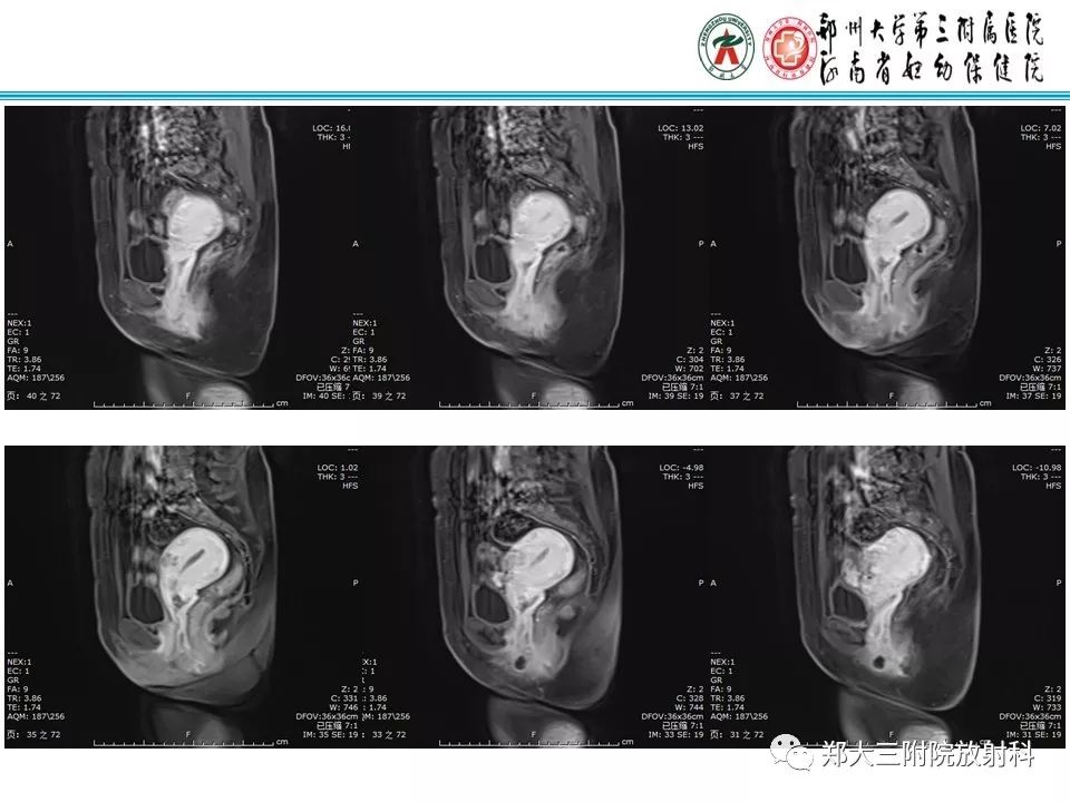 【病例】子宫静脉内平滑肌瘤病1例MR影像 【病例】子宫静脉内平滑肌瘤病1例MR影像