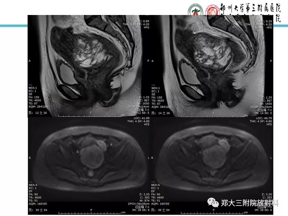 【病例】子宫静脉内平滑肌瘤病1例MR影像 【病例】子宫静脉内平滑肌瘤病1例MR影像