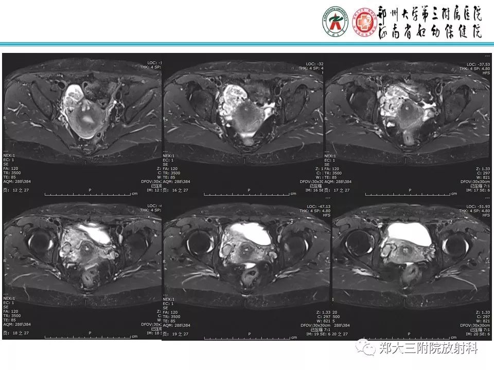 【病例】子宫静脉内平滑肌瘤病1例MR影像 【病例】子宫静脉内平滑肌瘤病1例MR影像