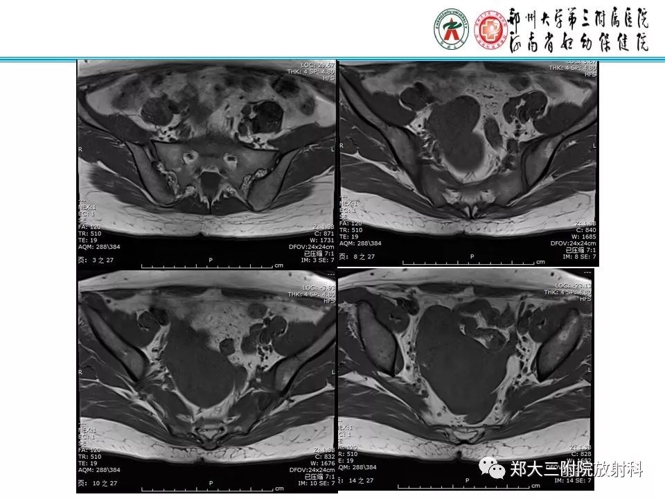 【病例】子宫静脉内平滑肌瘤病1例MR影像 【病例】子宫静脉内平滑肌瘤病1例MR影像