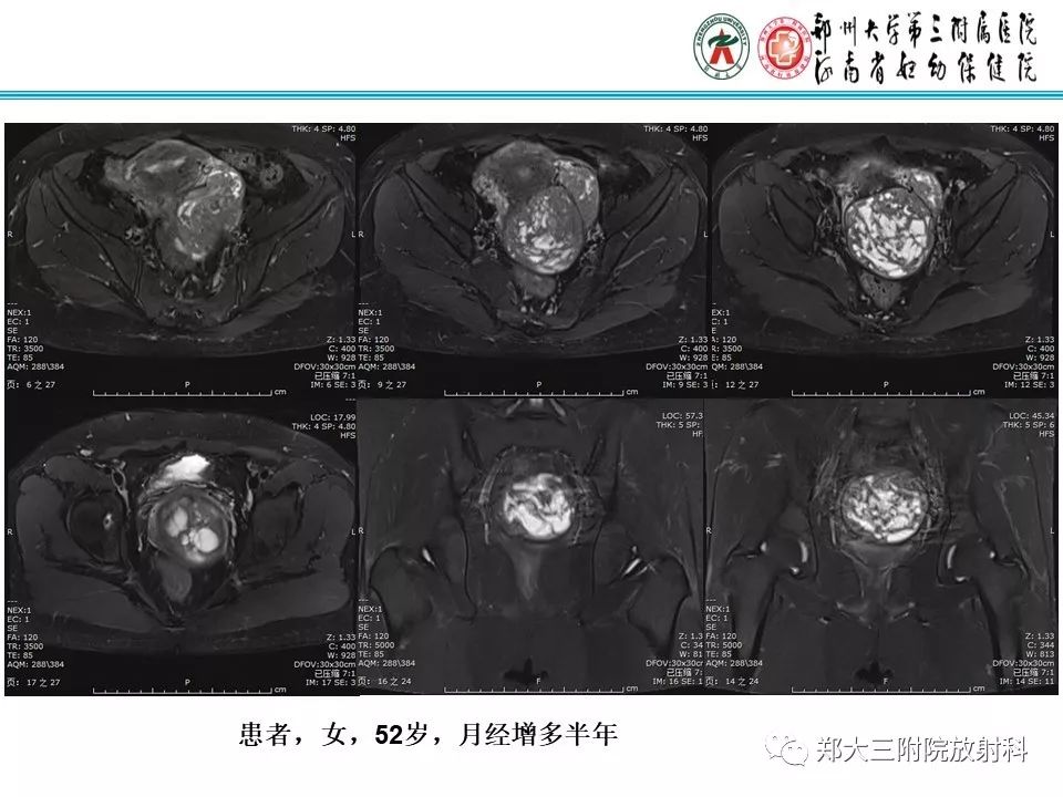 【病例】子宫静脉内平滑肌瘤病1例MR影像 【病例】子宫静脉内平滑肌瘤病1例MR影像