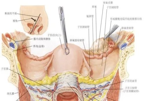 女性盆腔附件解剖及其常见肿瘤的影像表现