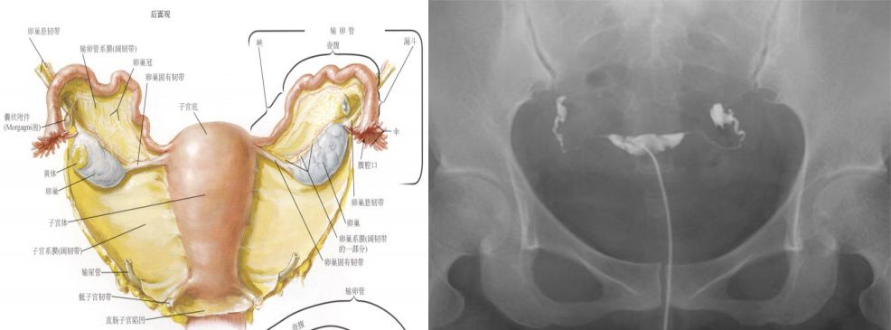 女性盆腔附件解剖及其常见肿瘤的影像表现