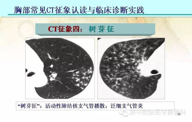 【PPT】胸部常见疾病的CT基本征象