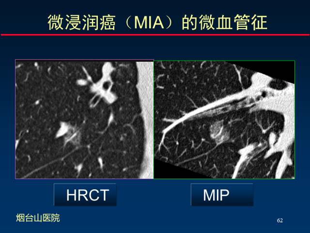 【PPT】肺癌CT征象的再探讨