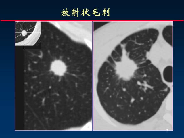【PPT】肺癌CT征象的再探讨