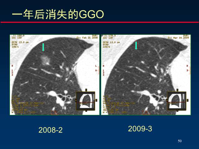 【PPT】肺癌CT征象的再探讨
