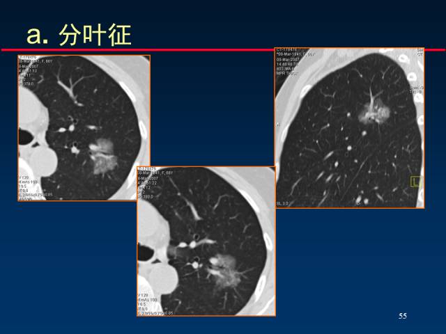 【PPT】肺癌CT征象的再探讨