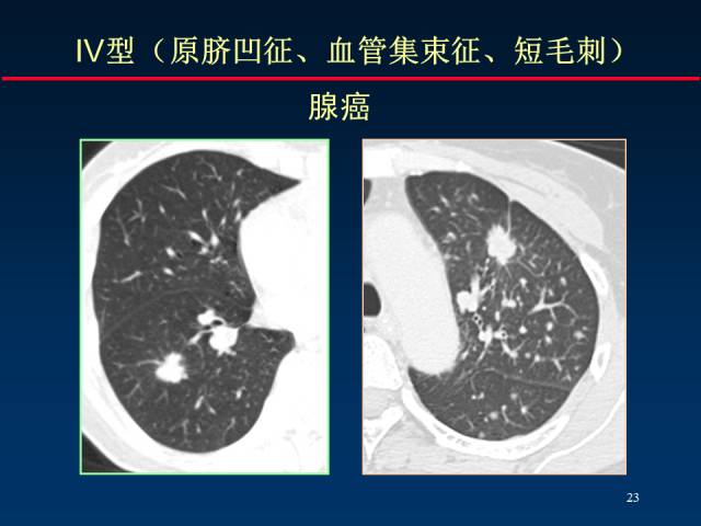 【PPT】肺癌CT征象的再探讨