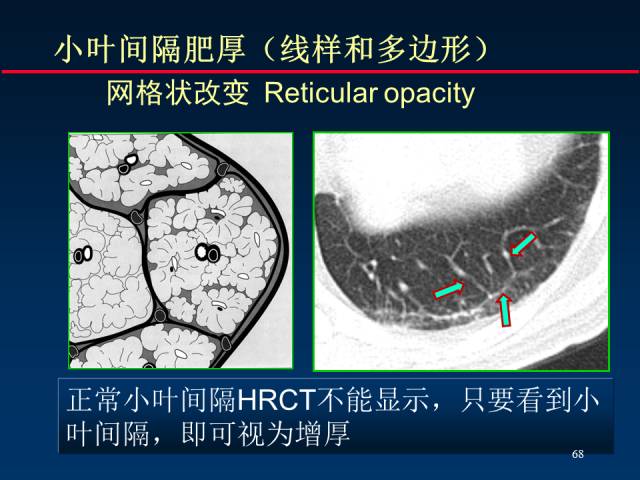 【PPT】肺癌CT征象的再探讨