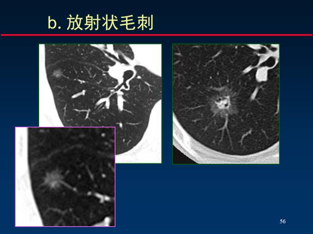 【PPT】肺癌CT征象的再探讨