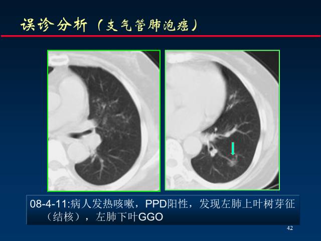 【PPT】肺癌CT征象的再探讨
