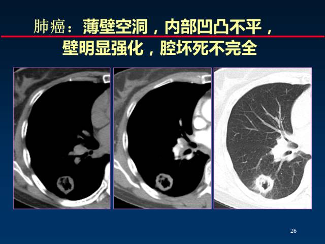 【PPT】肺癌CT征象的再探讨