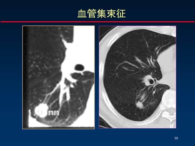 【PPT】肺癌CT征象的再探讨