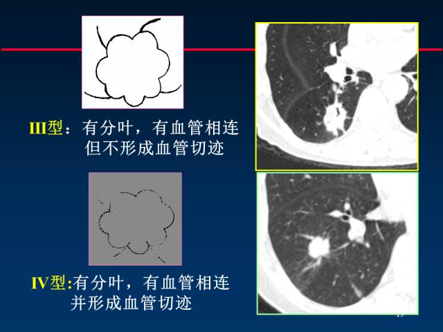 【PPT】肺癌CT征象的再探讨