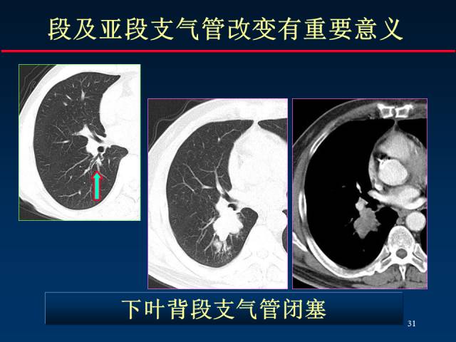 【PPT】肺癌CT征象的再探讨