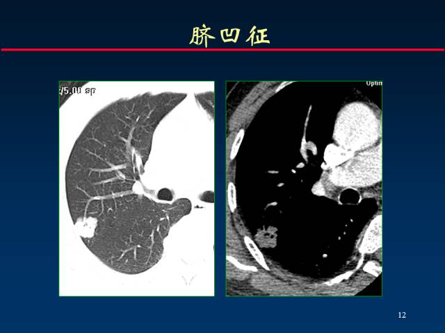 【PPT】肺癌CT征象的再探讨